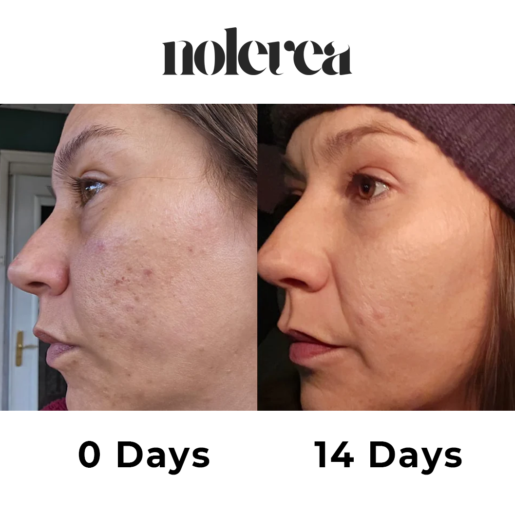 Retinol Boosting Shot Ampoule Nolevea™